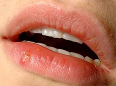 una fotografía de labios con un herpes labial