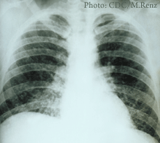 Un rayos-x de histoplasmosis pulmonar aguda en los pulmones