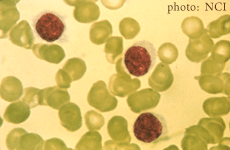 Lamina histológica de células pilosas de leucemia
