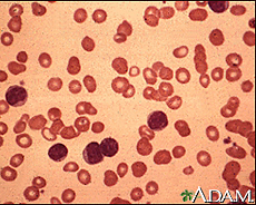 Fotografía microscópica de la médula ósea con leucemia linfocítica crónica