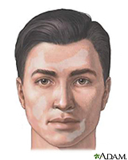 Ilustración de un hombre con lesiones de vitiligo en la cara