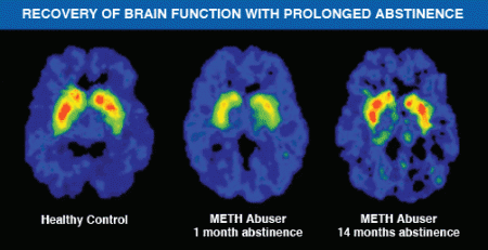 Brain scans showing that research is beginning to show that recovery of brain function may be possible with prolonged abstinence