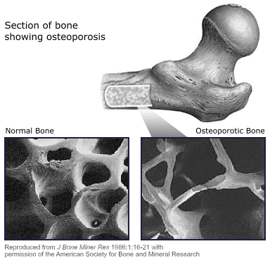 Section of bone showing osteoporosis