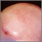 Alopecia total; vista frontal de la cabeza