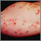 Dermatitis, herpetiformis on the forearm
