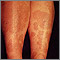 Granuloma, annulare on the legs