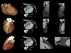 Image of a screening tool for Coronary Heart Disease.