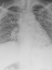 Image of x-ray of lung and heart.