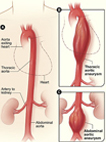 image of illustration of aortic aneurysm   