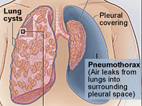 illustration showing lung cysts, collapsed lung and pneumothorax potentially associated with LAM