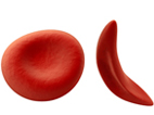 image of illustration of a normal and a sickled red blood cell