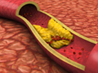 image of cross-section of blood vessel with cholesterol blockage 