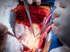 image of open heart surgery   