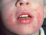 A child's face with Eczema