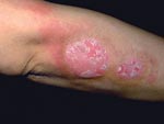 A Photo of an arm with Psoriasis