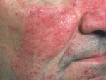 A Photo of a mans face with Rosacea