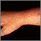 Polymorphic light eruption on the arm