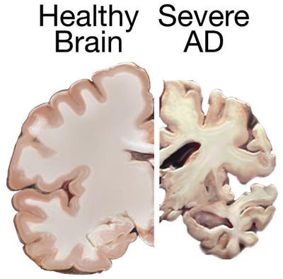 an illustration of a Healthy Brain and Severe Alzheimers brain