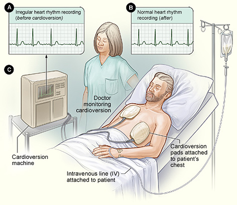 The image shows a typical setup for a nonemergency cardioversion. Figure A shows an irregular heart rhythm recording (before the cardioversion). Figure B shows a normal heart rhythm recording (after the cardioversion). Figure C shows the patient lying in bed with cardioversion pads attached to his body. The doctor closely watches the procedure.