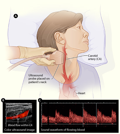 Figure A shows how the ultrasound probe (transducer) is placed over the carotid artery. Figure B is a color ultrasound image showing blood flow (the red color in the image) in the carotid artery. Figure C is a waveform image showing the sound of flowing blood in the carotid artery.