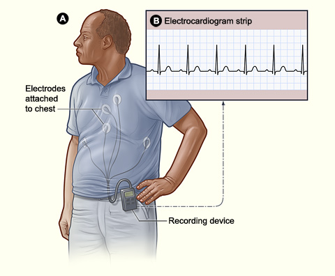 Figure A shows how a Holter or event monitor attaches to a patient. In this example, the monitor is clipped to the patient's belt and electrodes are attached to his chest. Figure B shows an electrocardiogram strip, which maps the data from the Holter or event monitor.