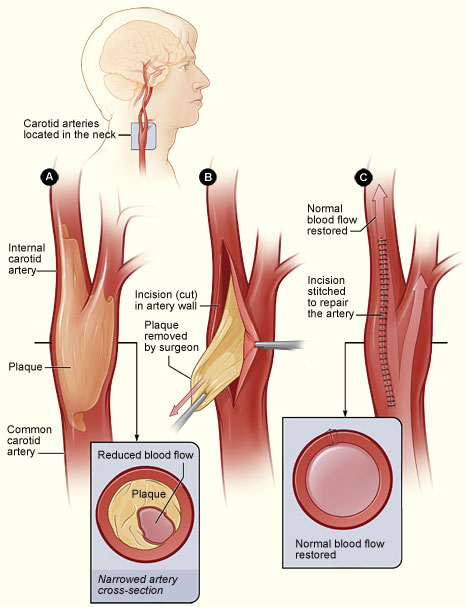 The illustration shows the process of carotid endarterectomy. Figure A shows a carotid artery that has plaque buildup. The inset image shows a cross-section of the narrowed carotid artery. Figure B shows how the carotid artery is cut and the plaque removed. Figure C shows the artery stitched up and normal blood flow restored. The inset image shows a cross-section of the artery with plaque removed and normal blood flow restored.