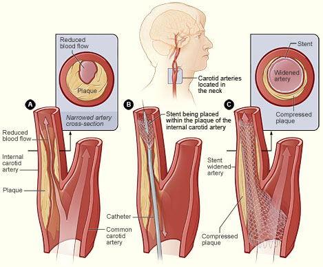 The illustration shows the process of carotid artery stenting. Figure A shows an internal carotid artery that has plaque buildup and reduced blood flow. The inset image shows a cross-section of the narrowed carotid artery. Figure B shows a stent being placed in the carotid artery to support the inner artery wall and keep the artery open. Figure C shows normal blood flow restored in the stent-widened artery. The inset image shows a cross-section of the stent-widened artery.