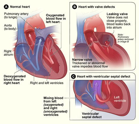 Figure A shows the structure and blood flow inside a normal heart. Figure B shows a heart with leaking and narrowed valves. Figure C shows a heart with a ventricular septal defect.