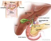 Anatomy of the extrahepatic bile duct; drawing shows the liver, right and left hepatic ducts, gallbladder, cystic duct, common hepatic duct (perihilar), common bile duct (distal), extrahepatic bile duct, small intestine, and pancreas. The inset shows the liver, bile ducts, gallbladder, pancreas, and small intestine.