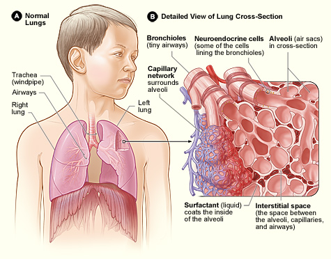 Figure A shows the location of the lungs and airways in the body. Figure B is a detailed view of the lung structures that childhood interstitial lung disease may affect, such as the bronchioles, neuroendocrine cells, alveoli, capillary network, surfactant, and interstitial space. 