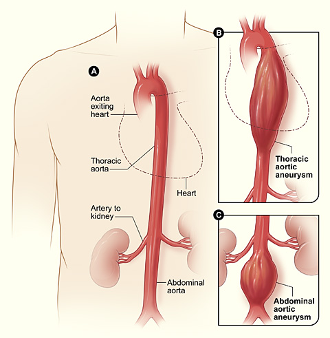Figure A shows a normal aorta. Figure B shows a thoracic aortic aneurysm, which is located behind the heart. Figure C shows an abdominal aortic aneurysm, which is located below the arteries that supply blood to the kidneys.