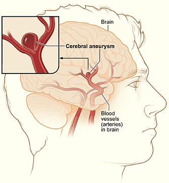 The illustration shows a typical location of a brain aneurysm in the arteries that supply blood to the brain. The inset image shows a closeup view of the sac-like aneurysm.