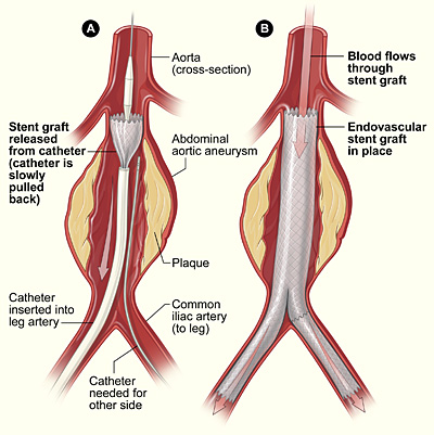 The illustration shows the placement of a stent graft in an aortic aneurysm. In figure A, a catheter is inserted into an artery in the groin (upper thigh). The catheter is threaded to the abdominal aorta, and the stent graft is released from the catheter. In figure B, the stent graft allows blood to flow through the aneurysm.