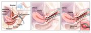 Dilatation and curettage (D and C). Three-panel drawing showing a side view of the female reproductive anatomy during a D and C procedure. The first panel shows a speculum widening the opening of the vagina. The cervix, uterus with abnormal tissue, bladder, and rectum are also shown; an inset shows the lower half of a woman covered by a drape on an exam table with her legs apart  and her feet in stirrups. The middle panel shows the uterus and a dilator inserted through the vagina into the cervix. The third panel shows a curette scraping out abnormal tissue from the uterus; an inset shows a close up of the curette with the abnormal tissue in it.