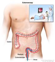 Colonoscopy; shows colonoscope inserted through the anus and rectum and into the colon.  Inset shows patient on table having a colonoscopy.
