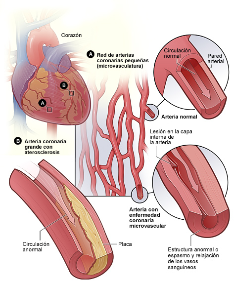 La figura A muestra la red de arterias coronarias pequeñas (microvasculatura) que contiene una arteria normal y otra con enfermedad coronaria microvascular. La Figura B muestra una arteria coronaria grande con depósito de placa.