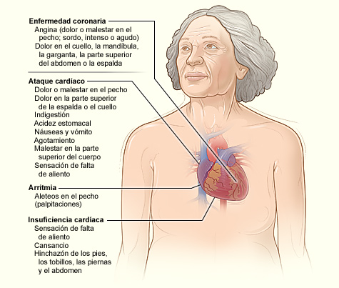 La ilustración muestra los principales signos y síntomas de la enfermedad coronaria.