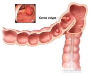Colon polyps; shows two polyps (one flat and one pedunculated) inside the colon.  Inset shows photo of a pedunculated polyp.
