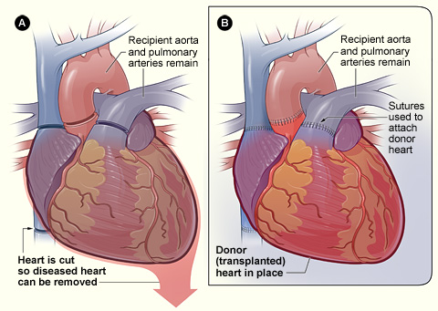 Figure A shows where the diseased heart is cut for removal. Figure B shows where the healthy donor heart is sutured (stitched) to the recipient's arteries and veins.