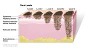 Clark levels of skin cancer; drawing shows skin with five thin lesions of different depths. In the first lesion (Clark Level I), the cancer is in the epidermis only. In the second lesion (Clark Level II), the cancer has begun to spread into the papillary dermis (upper layer of the dermis). In the third lesion (Clark Level III), the cancer has spread through the papillary dermis into the papillary-reticular dermal interface but not into the reticular dermis (lower layer of the dermis). In the fourth lesion (Clark Level IV), the cancer has spread into the reticular dermis. In the fifth lesion (Clark Level V), the cancer has spread into the subcutaneous tissue.