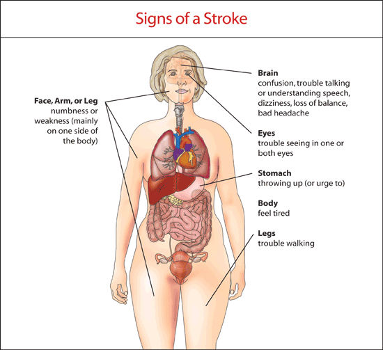 Signs of a stroke