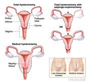 Hysterectomy; drawing shows the female reproductive anatomy, including the ovaries, uterus, vagina, fallopian tubes, and cervix. Dotted lines show which organs and tissues are removed in a total hysterectomy, a total hysterectomy with salpingo-oophorectomy, and a radical hysterectomy. An inset shows the location of two possible incisions on the abdomen: a low transverse incision is just above the pubic area and a vertical incision is between the navel and the pubic area.