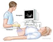 Abdominal ultrasound; drawing shows a woman on an exam table during an abdominal ultrasound procedure. A diagnostic sonographer (a person trained to perform ultrasound procedures) is shown passing a transducer (a device that makes sound waves that bounce off tissues inside the body) over the surface of the patient’s abdomen. A computer screen shows a sonogram (computer picture).