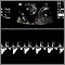 Ultrasonido normal de los latidos del feto