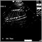 Ultrasonido de un feto normal; columna y costillas