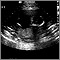 Ultrasonido de un feto normal; ventrículos cerebrales