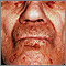 Amyloidosis on the face