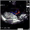 Ultrasound, color - normal umbilical cord