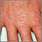 Dermatomyositis, Gottron's papules on the hand