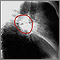 Lung cancer, lateral chest X-ray